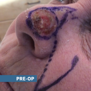 nose with skin cancer outlined for cuts