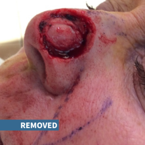 picture of nose with skin cancer removed