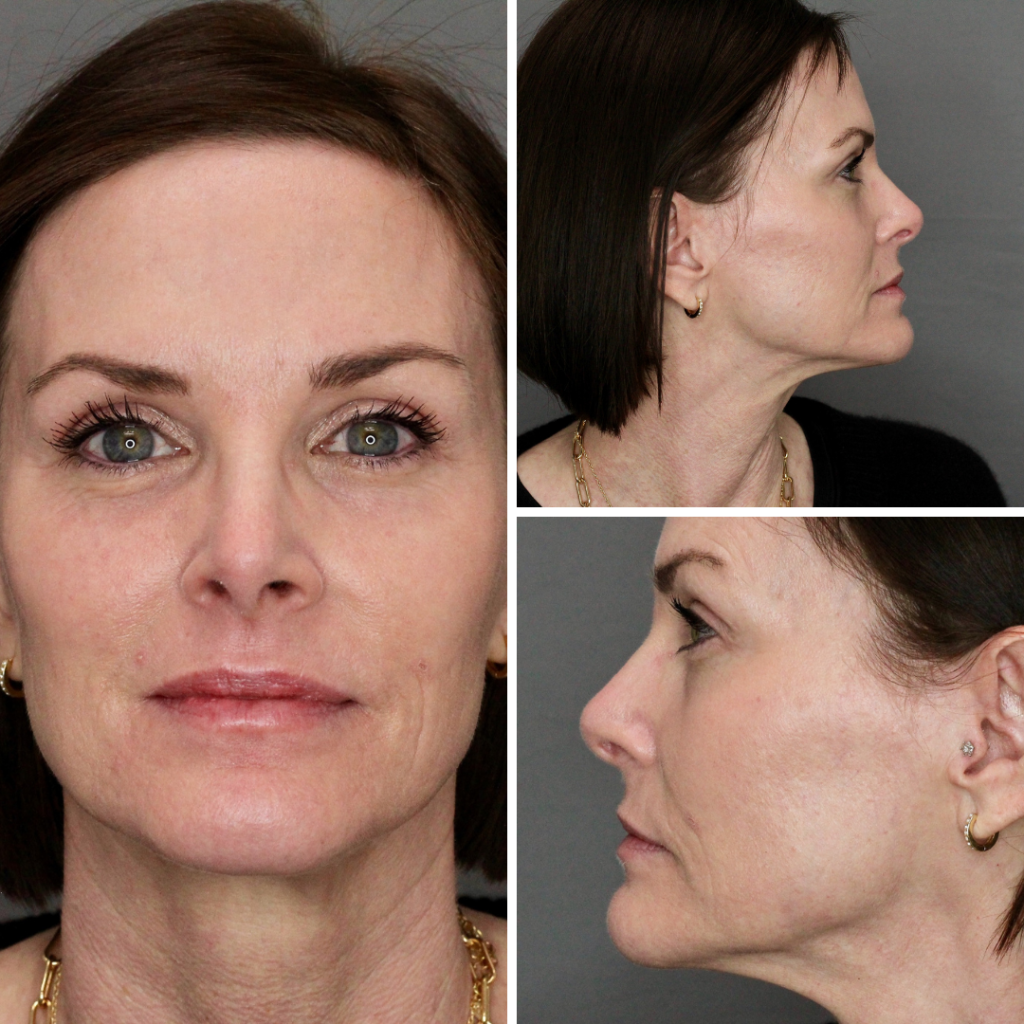 Front and side pics of Michele after 2nd co2 laser treatment