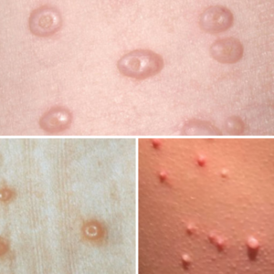 examples of molluscum on different skin colors for discussing the spread and treatment