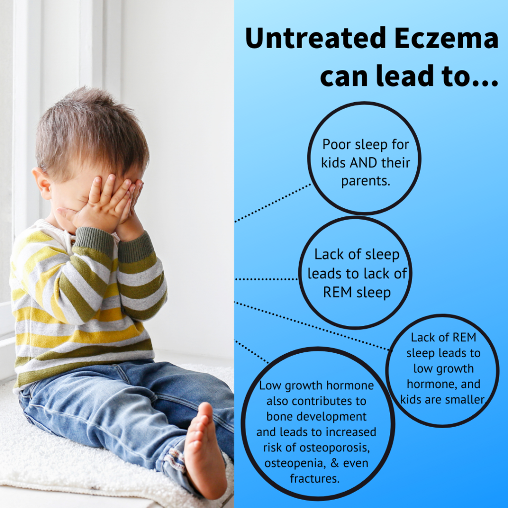 eczema and atopic dermatitis can lead to lack of sleep, lack of growth and bone development problems