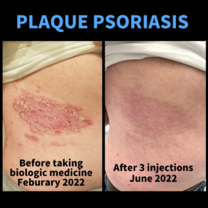 before and after pictures of a patient with plaque psoriasis