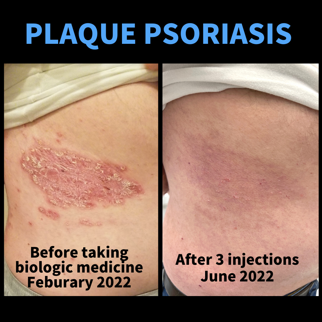 Life changing relief from biologics for our patient with plaque