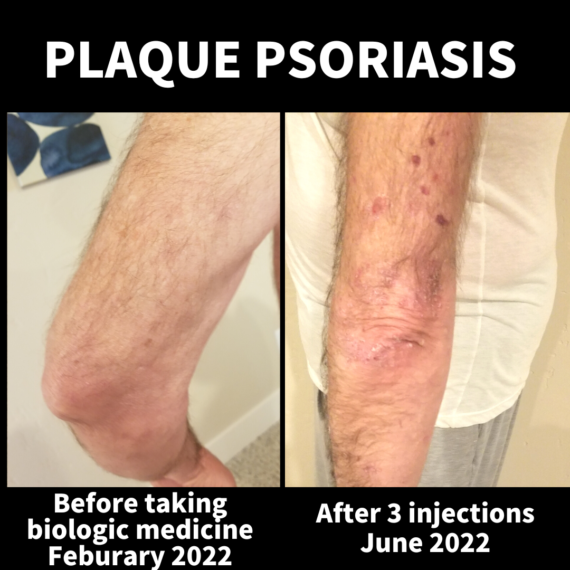 Life changing relief from biologics for our patient with plaque