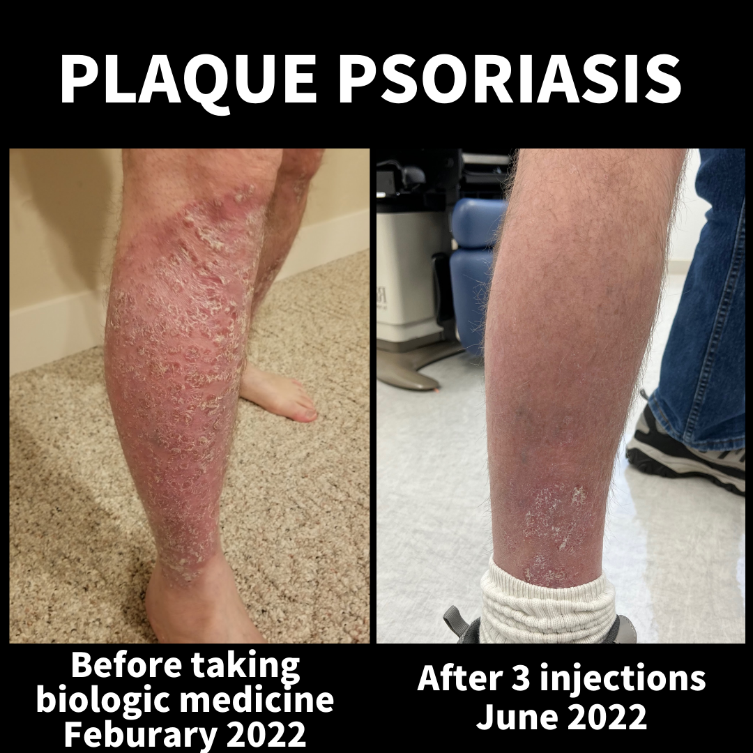 Life changing relief from biologics for our patient with plaque