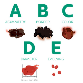 the abcde's of mole risk factors for seeing a dermatologist