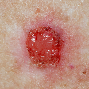 signs of basal cell or squamous cell carcinoma skin caner to see a dermatologist