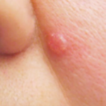 basal cell carcinoma bcc are reasons to see a dermatologist