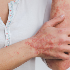 Psoriasis on hands and elbows is a good reason to see a dermatologist