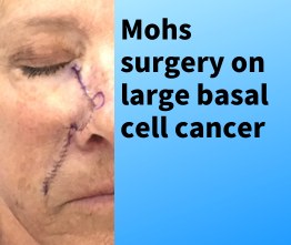 mohs surgery on nose