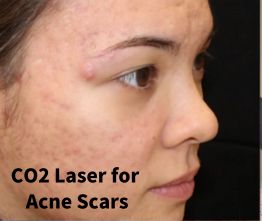 Co2 Laser for acner scarring before procedure