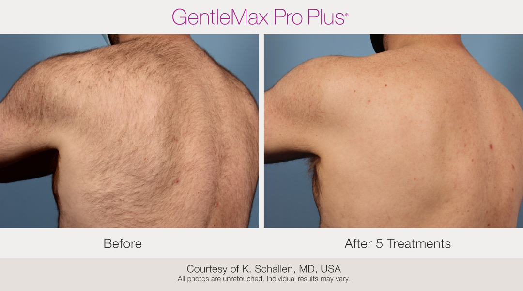 gentlemaxpro-beforeandafter5